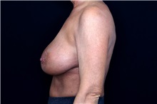 Breast Implant Removal Before Photo by Landon Pryor, MD, FACS; Rockford, IL - Case 49429