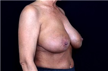 Breast Implant Removal Before Photo by Landon Pryor, MD, FACS; Rockford, IL - Case 49429