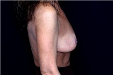 Breast Implant Removal After Photo by Landon Pryor, MD, FACS; Rockford, IL - Case 49429