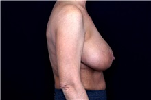 Breast Implant Removal Before Photo by Landon Pryor, MD, FACS; Rockford, IL - Case 49429