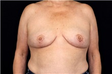 Breast Implant Removal After Photo by Landon Pryor, MD, FACS; Rockford, IL - Case 49434