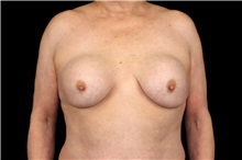 Breast Implant Removal Before Photo by Landon Pryor, MD, FACS; Rockford, IL - Case 49434