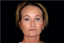 Brow Lift After Photo by Landon Pryor, MD, FACS; Rockford, IL - Case 49437