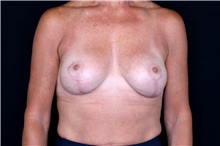 Breast Lift After Photo by Landon Pryor, MD, FACS; Rockford, IL - Case 49440