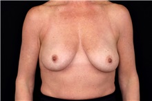 Breast Lift Before Photo by Landon Pryor, MD, FACS; Rockford, IL - Case 49440