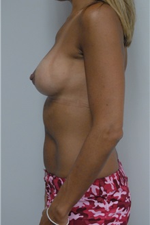 Breast Lift After Photo by Jonathan Hall, MD; Stoneham, MA - Case 23503