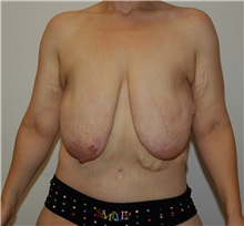 Body Contouring Before Photo by Jonathan Hall, MD; Stoneham, MA - Case 23504