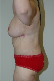 Body Contouring After Photo by Jonathan Hall, MD; Stoneham, MA - Case 23504