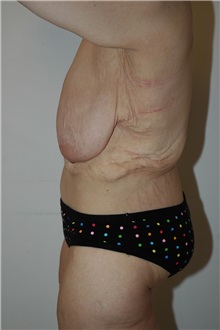 Body Contouring Before Photo by Jonathan Hall, MD; Stoneham, MA - Case 23504
