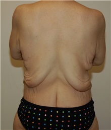 Body Contouring Before Photo by Jonathan Hall, MD; Stoneham, MA - Case 23504