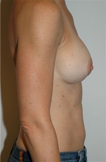 Breast Augmentation After Photo by Jonathan Hall, MD; Stoneham, MA - Case 23505