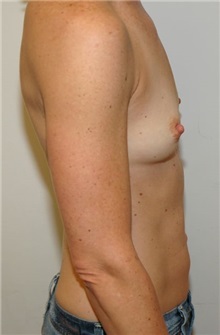 Breast Augmentation Before Photo by Jonathan Hall, MD; Stoneham, MA - Case 23505