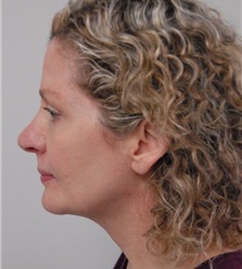 Rhinoplasty After Photo by Jonathan Hall, MD; Stoneham, MA - Case 23506