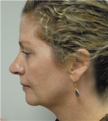 Rhinoplasty Before Photo by Jonathan Hall, MD; Stoneham, MA - Case 23506