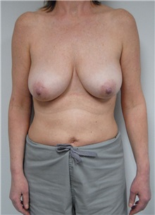 Breast Lift Before Photo by Jonathan Hall, MD; Stoneham, MA - Case 23508