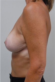 Breast Lift After Photo by Jonathan Hall, MD; Stoneham, MA - Case 23508