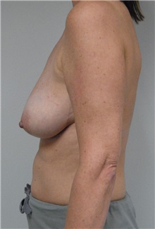 Breast Lift Before Photo by Jonathan Hall, MD; Stoneham, MA - Case 23508