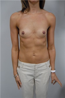 Breast Augmentation Before Photo by Jonathan Hall, MD; Stoneham, MA - Case 23515