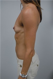 Breast Augmentation Before Photo by Jonathan Hall, MD; Stoneham, MA - Case 23515