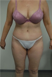 Tummy Tuck After Photo by Jonathan Hall, MD; Stoneham, MA - Case 23516