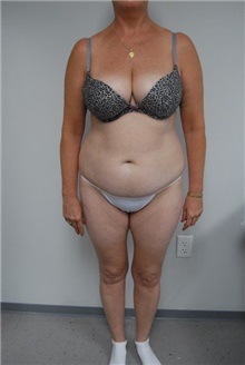 Tummy Tuck Before Photo by Jonathan Hall, MD; Stoneham, MA - Case 23516