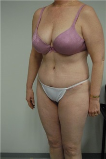 Tummy Tuck After Photo by Jonathan Hall, MD; Stoneham, MA - Case 23516