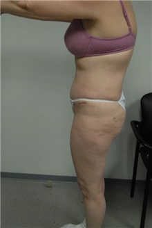 Tummy Tuck After Photo by Jonathan Hall, MD; Stoneham, MA - Case 23516