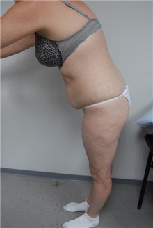 Tummy Tuck Before Photo by Jonathan Hall, MD; Stoneham, MA - Case 23516