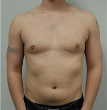 Male Breast Reduction After Photo by Jonathan Hall, MD; Stoneham, MA - Case 23521