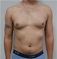 Male Breast Reduction Before Photo by Jonathan Hall, MD; Stoneham, MA - Case 23521