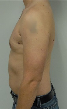 Male Breast Reduction After Photo by Jonathan Hall, MD; Stoneham, MA - Case 23521