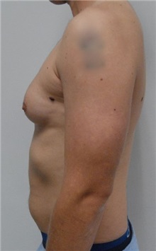 Male Breast Reduction Before Photo by Jonathan Hall, MD; Stoneham, MA - Case 23521