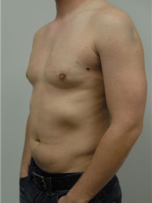 Male Breast Reduction After Photo by Jonathan Hall, MD; Stoneham, MA - Case 23521