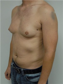 Male Breast Reduction Before Photo by Jonathan Hall, MD; Stoneham, MA - Case 23521