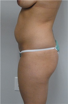 Tummy Tuck Before Photo by Jonathan Hall, MD; Stoneham, MA - Case 23522