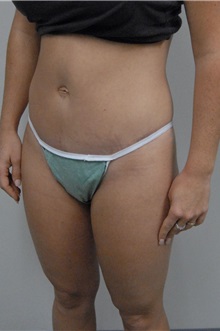 Tummy Tuck After Photo by Jonathan Hall, MD; Stoneham, MA - Case 23522
