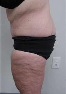 Body Contouring After Photo by Jonathan Hall, MD; Stoneham, MA - Case 23525