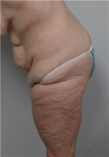 Body Contouring Before Photo by Jonathan Hall, MD; Stoneham, MA - Case 23525