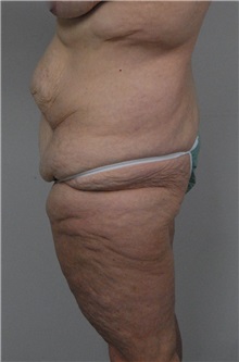 Body Contouring Before Photo by Jonathan Hall, MD; Stoneham, MA - Case 23525
