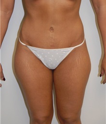 Tummy Tuck After Photo by Jonathan Hall, MD; Stoneham, MA - Case 23526