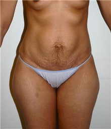 Tummy Tuck Before Photo by Jonathan Hall, MD; Stoneham, MA - Case 23526