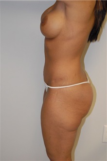 Tummy Tuck After Photo by Jonathan Hall, MD; Stoneham, MA - Case 23526