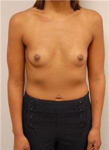 Breast Augmentation Before Photo by Jonathan Hall, MD; Stoneham, MA - Case 23527