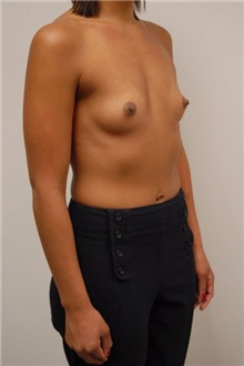 Breast Augmentation Before Photo by Jonathan Hall, MD; Stoneham, MA - Case 23527