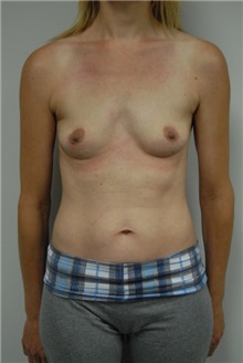 Breast Augmentation Before Photo by Jonathan Hall, MD; Stoneham, MA - Case 23528