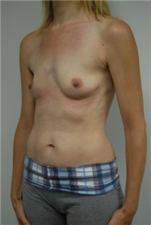 Breast Augmentation Before Photo by Jonathan Hall, MD; Stoneham, MA - Case 23528