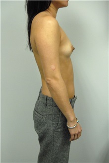 Breast Augmentation Before Photo by Jonathan Hall, MD; Stoneham, MA - Case 23531