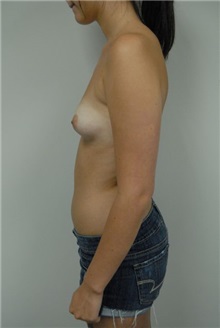 Breast Augmentation Before Photo by Jonathan Hall, MD; Stoneham, MA - Case 24002