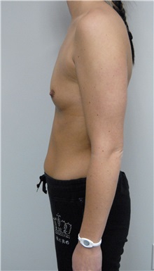 Breast Augmentation Before Photo by Jonathan Hall, MD; Stoneham, MA - Case 24037