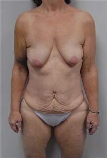 Body Contouring Before Photo by Jonathan Hall, MD; Stoneham, MA - Case 24080